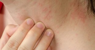 Are Shingles And Eczema Related