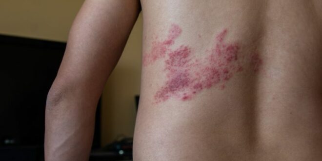 Are Shingles And Herpes Related
