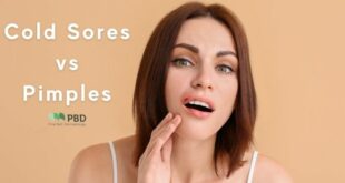 Cold Sores And Herpes Difference