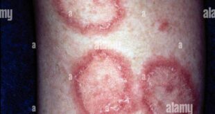 Is Lupus And Psoriasis Related